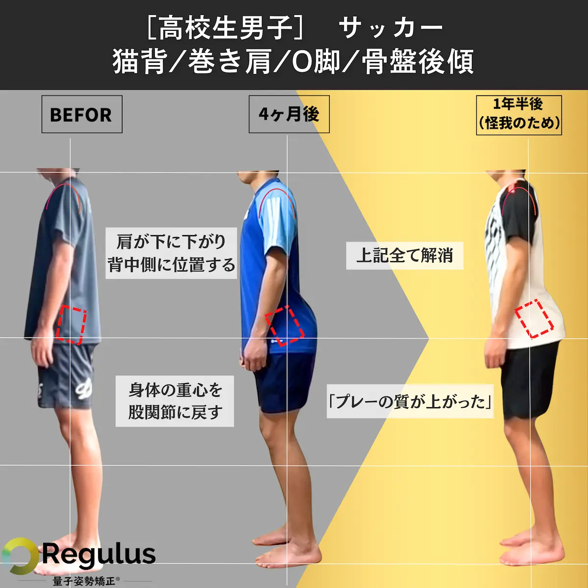 [高校生男子]サッカー／猫背／巻き肩／O脚／骨盤後傾