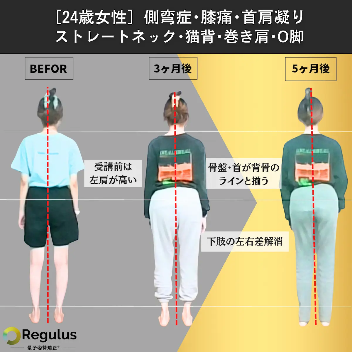 [24歳女性]側弯症・膝痛・首肩凝り ストレートネック・猫背・巻き肩・O脚>