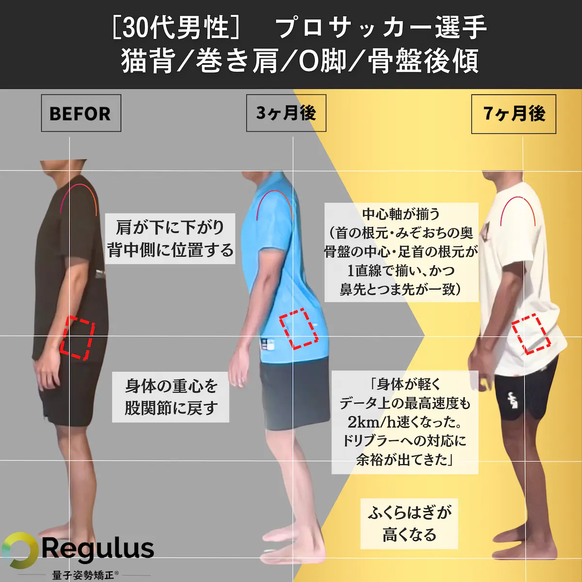 [30代男性]プロサッカー選手／猫背／巻き肩／O脚／骨盤後傾