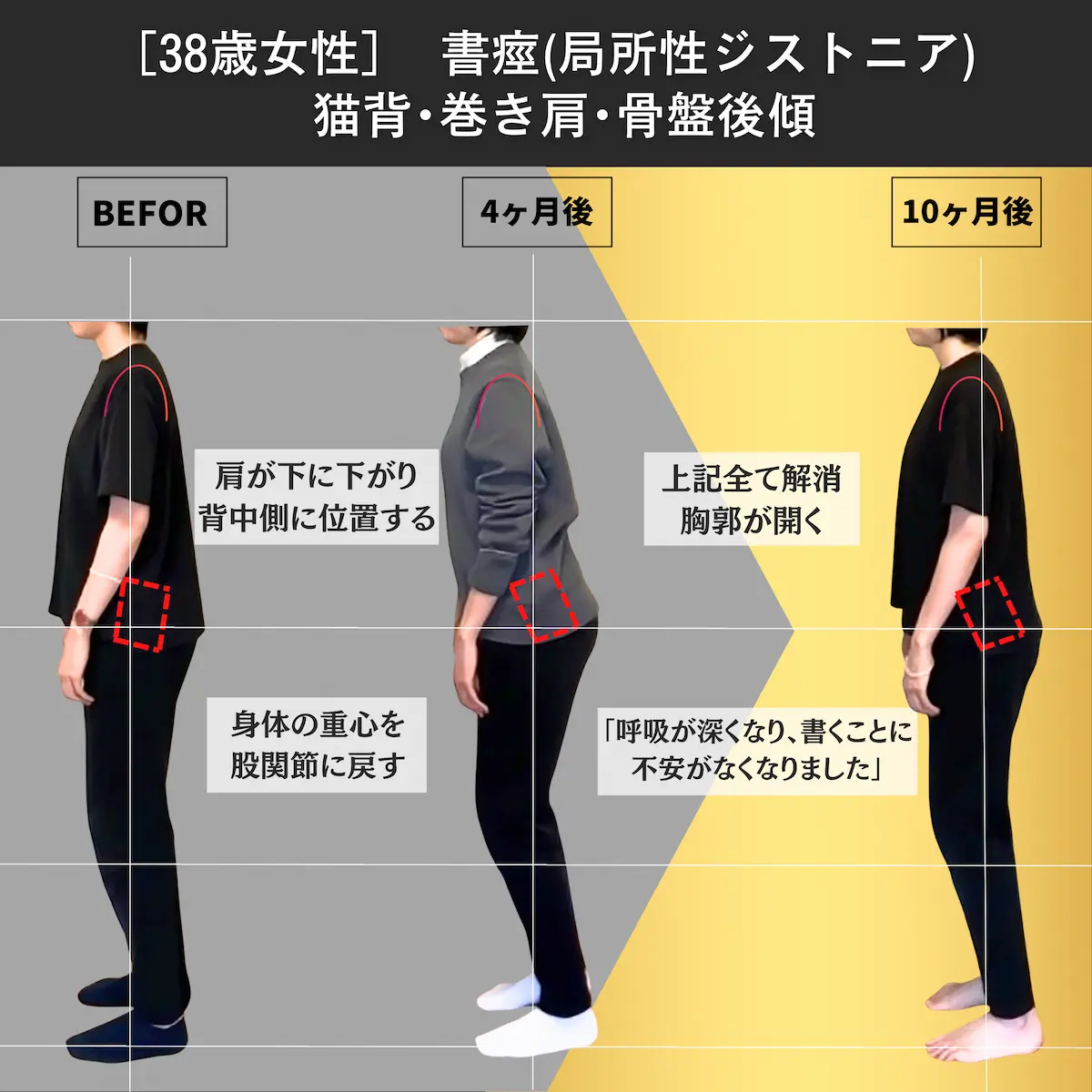 [38歳女性]書痙（局所性ジストニア）・猫背・巻き肩・骨盤後傾