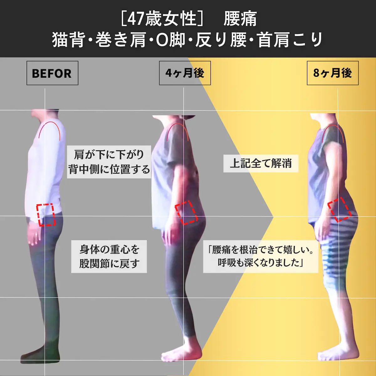[47歳女性]腰痛・猫背・巻き肩・O脚・反り腰・首肩こり