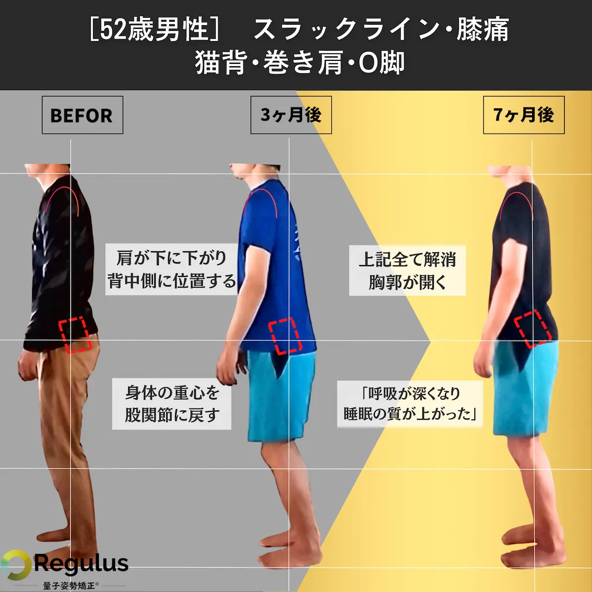 [52歳男性]スラックライン・膝痛・猫背・巻き肩・O脚