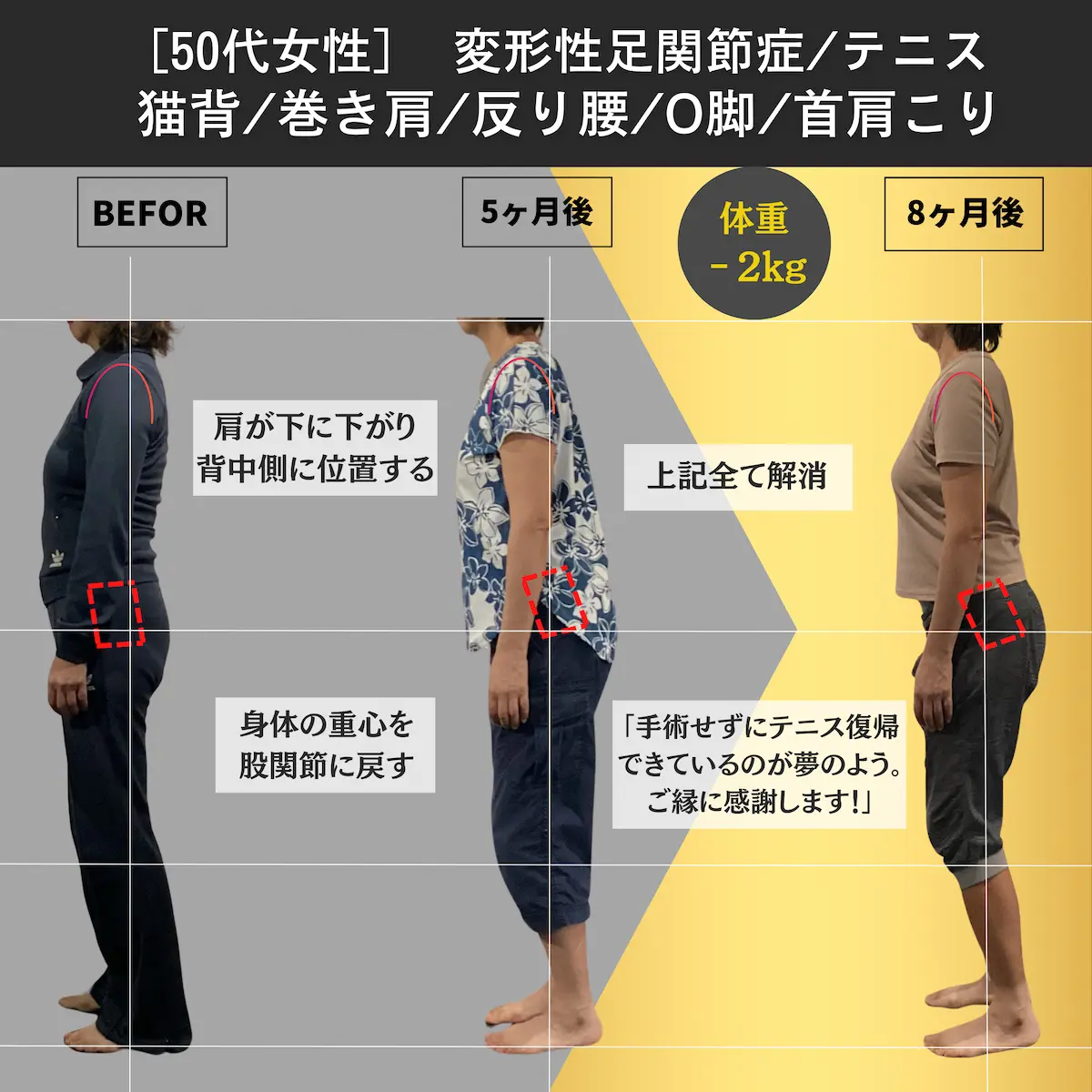 [50代女性]変形性足関節症／テニス／猫背／巻き肩／反り腰／O脚／首肩こり