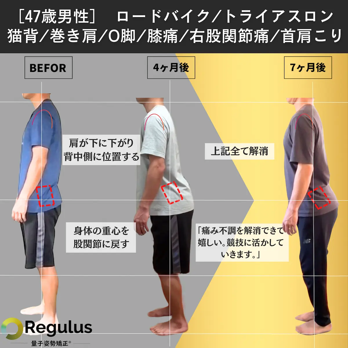 [47歳男性]ロードバイク／トライアスロン／猫背／巻き肩／O脚／膝痛／右股関節症／首肩こり