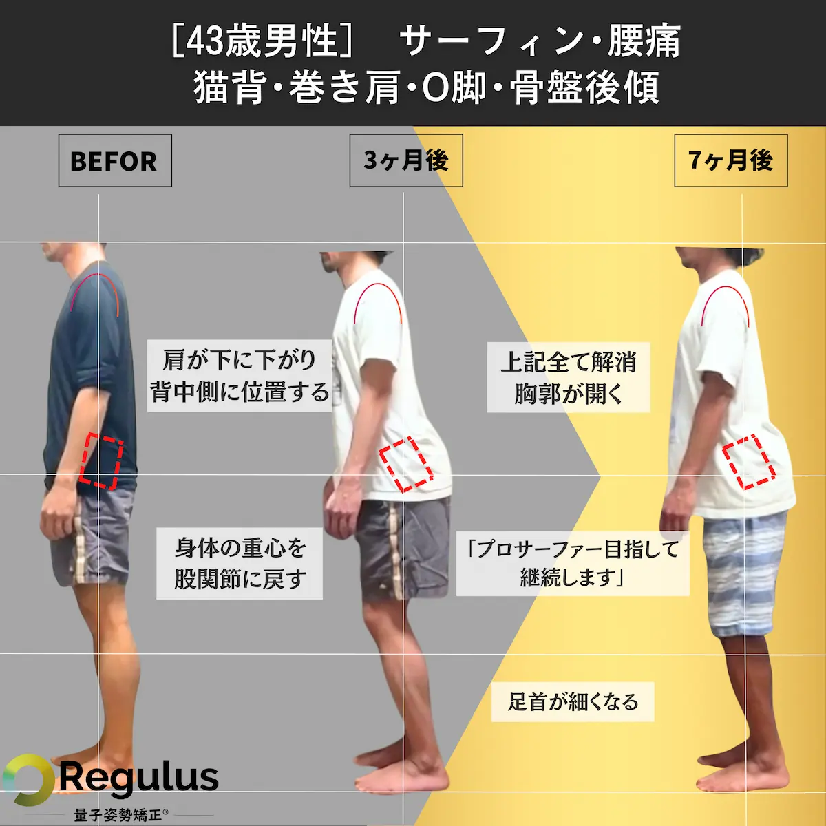 [43歳男性]サーフィン・腰痛・猫背・巻き肩・O脚・骨盤後傾