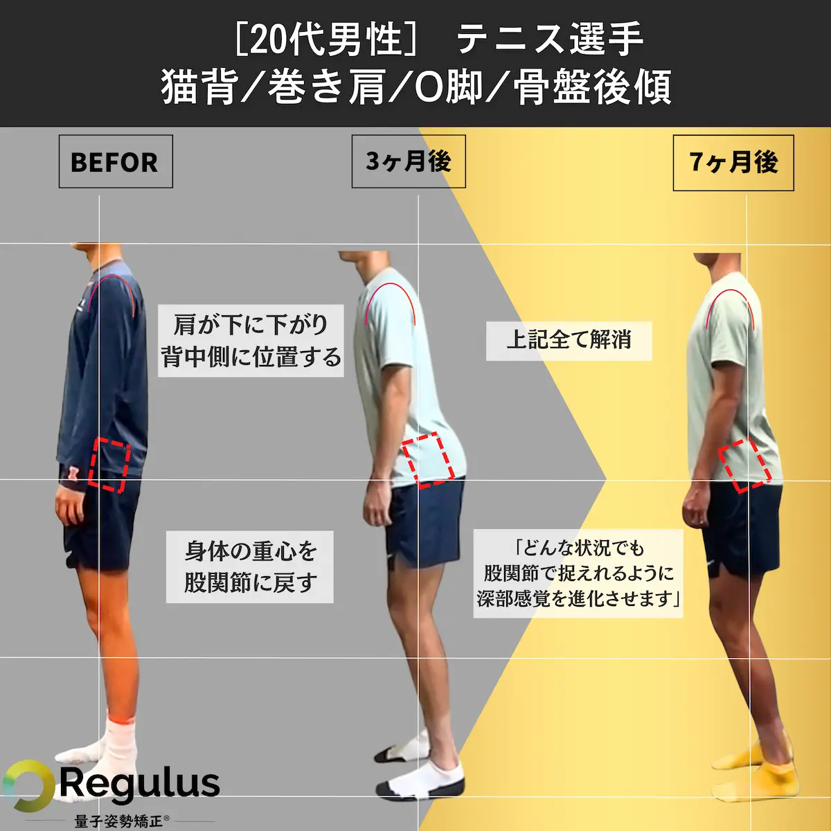 [20代男性]テニス選手　猫背／巻き肩／O脚／骨盤後傾