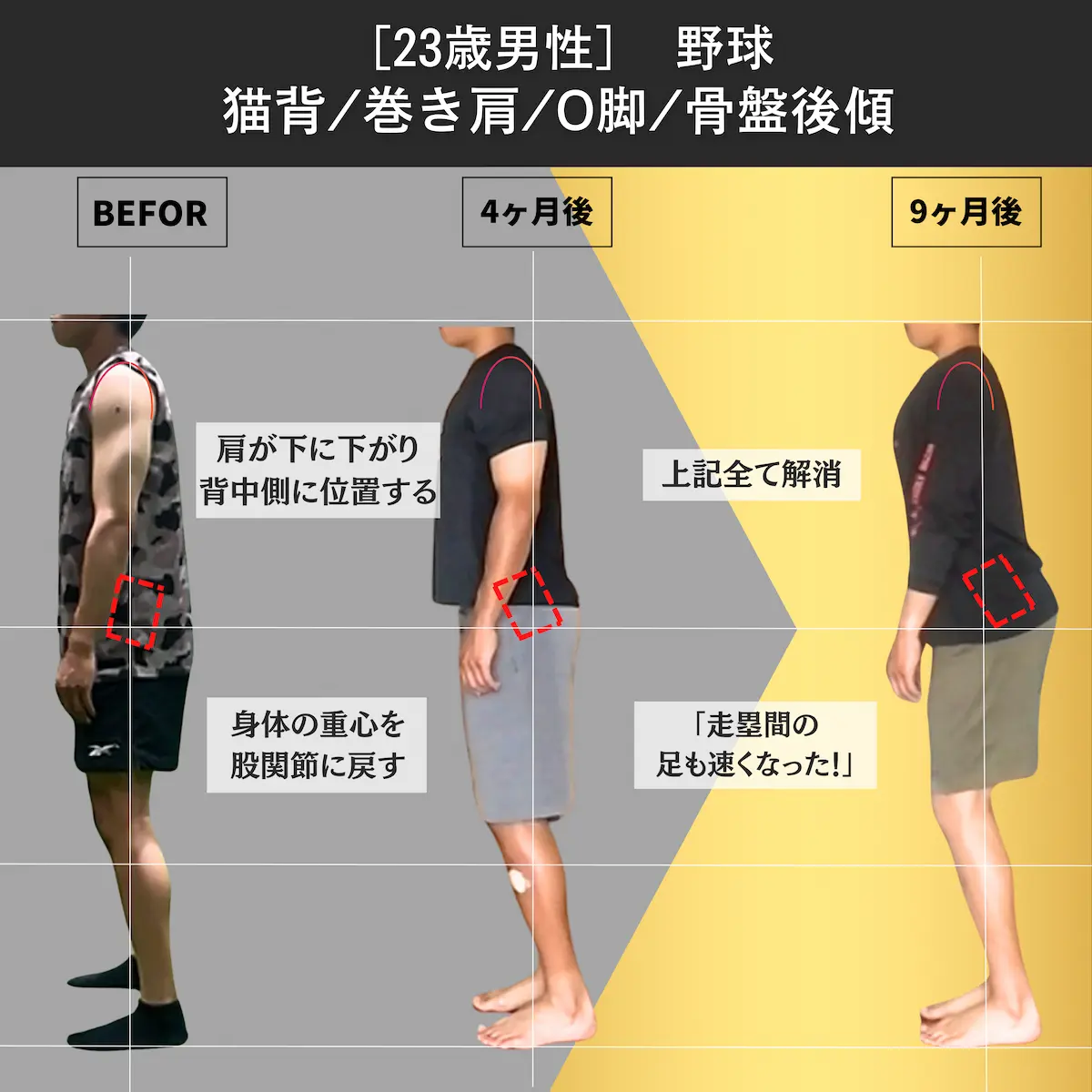 [23歳男性]野球　猫背／巻き肩／O脚／骨盤後傾