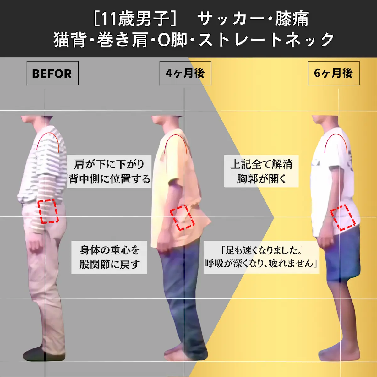 [11歳男子]サッカー・膝痛・猫背・巻き肩・O脚・ストレートネック