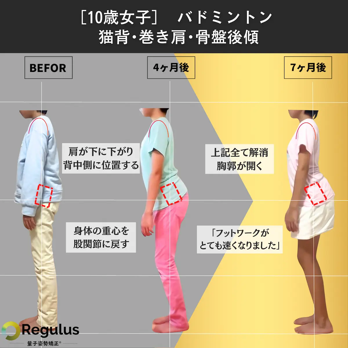 [10歳女子]バドミントン　猫背・巻き肩・骨盤後傾