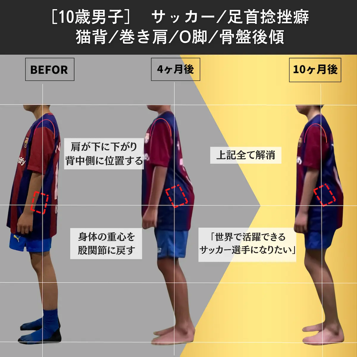 [10歳男子]サッカー／足首捻挫癖／猫背／巻き肩／O脚／骨盤後傾