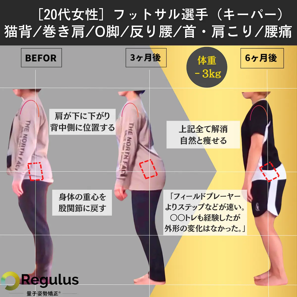 [20代女性]フットサル選手（キーパー）　猫背／巻き肩／O脚／反り腰／首肩こり／腰痛