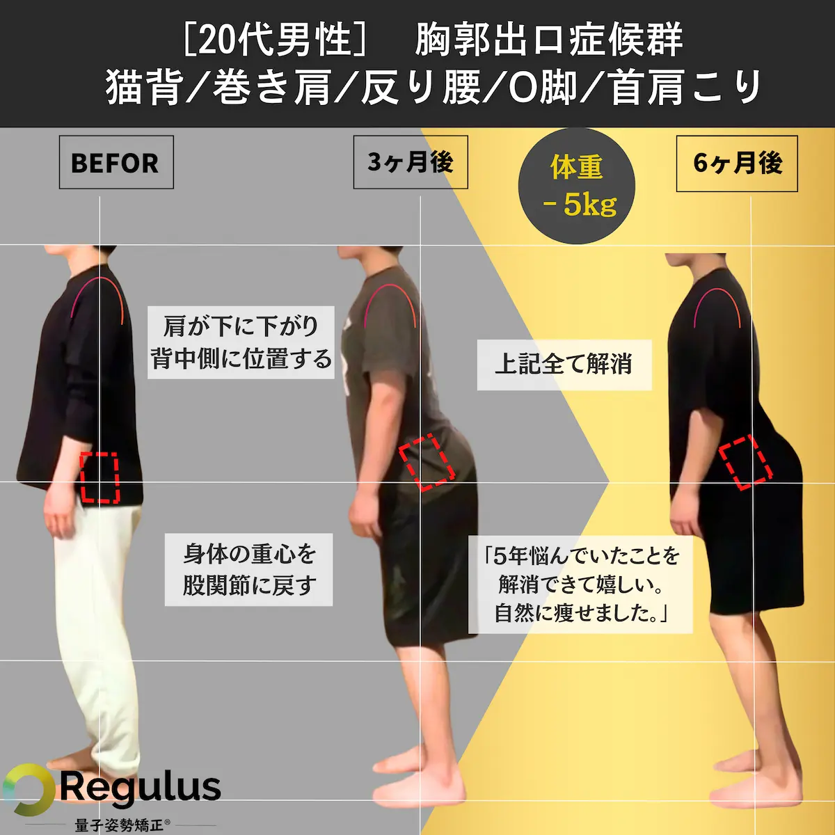 [20代男性]胸郭出口症候群　猫背／巻き肩／反り腰／O脚／首肩こり