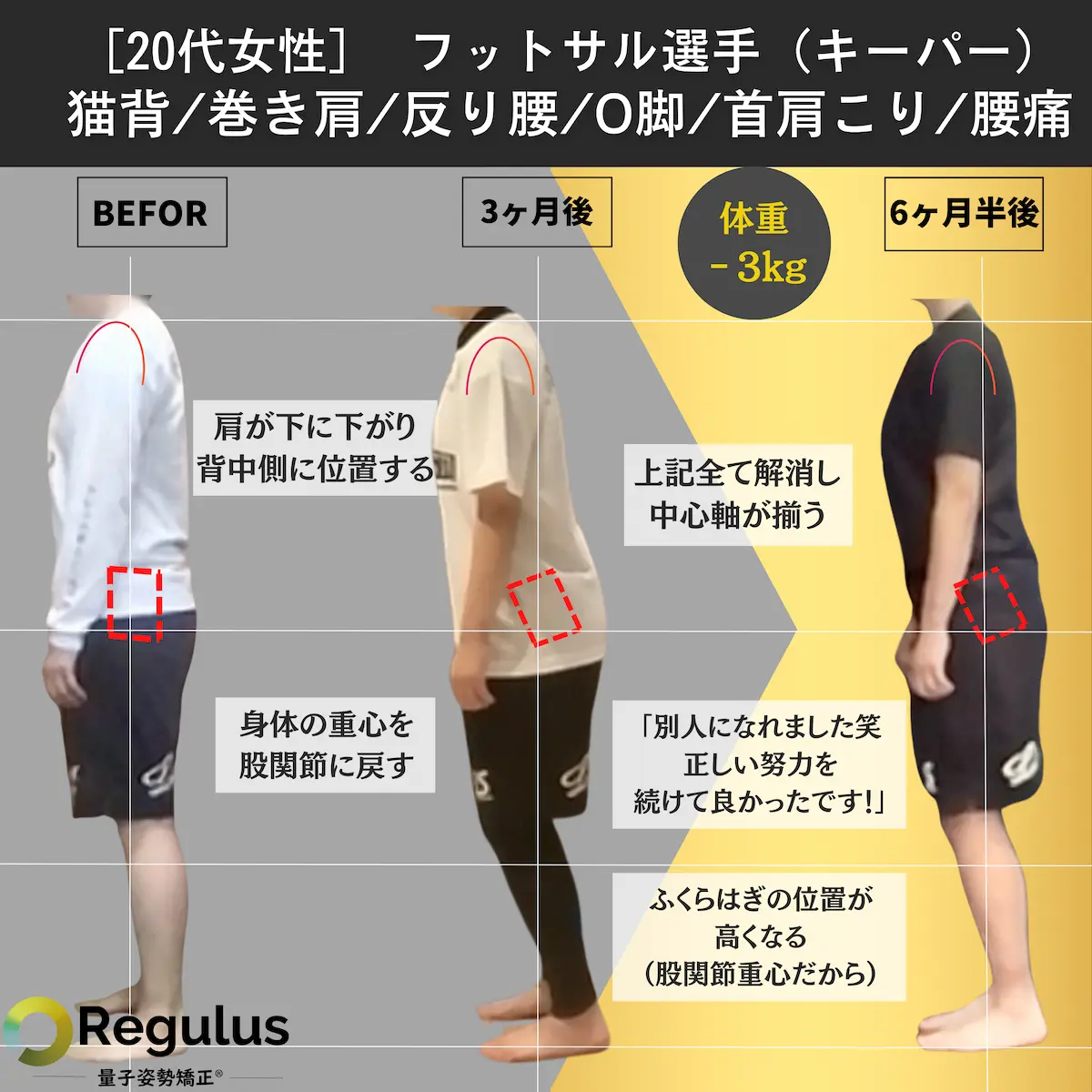 [20代女性]フットサル選手（キーパー）　猫背／巻き肩／反り腰／O脚／首肩こり／腰痛