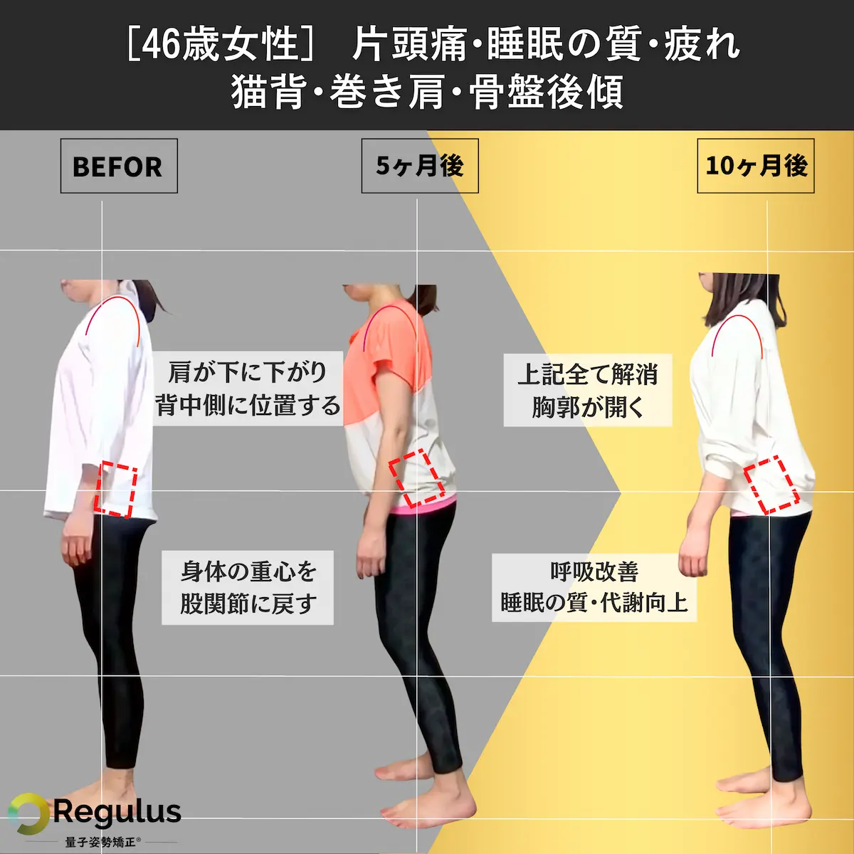 [46歳女性]片頭痛・睡眠の質・疲れ・猫背・巻き肩・骨盤後傾