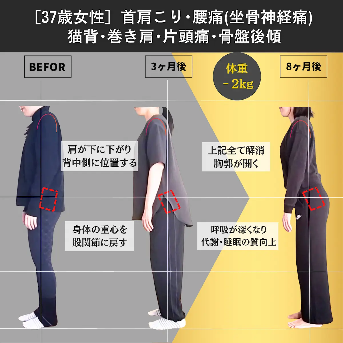 [37歳女性]首肩こり・腰痛（坐骨神経痛）・猫背・巻き肩・片頭痛・骨盤後傾