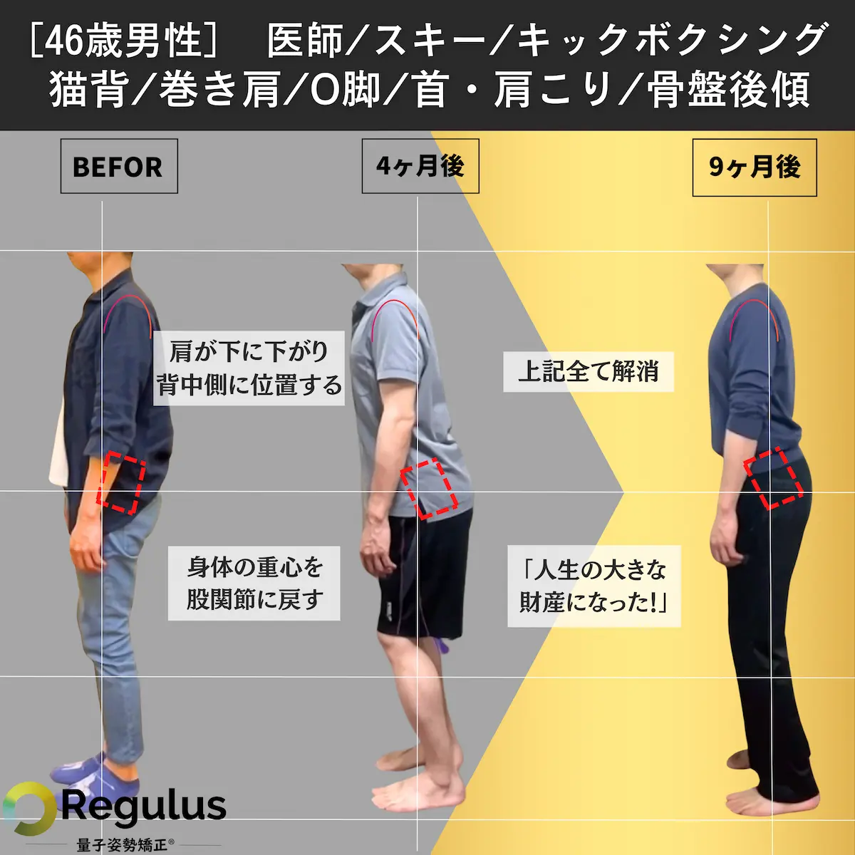 [46歳男性]医師／スキー／キックボクシング／猫背／巻き肩／O脚／首肩こり／骨盤後傾