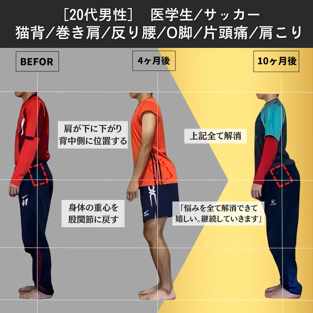 [20代男性]医学生／サッカー／猫背／巻き肩／反り腰／O脚／片頭痛／首肩こり