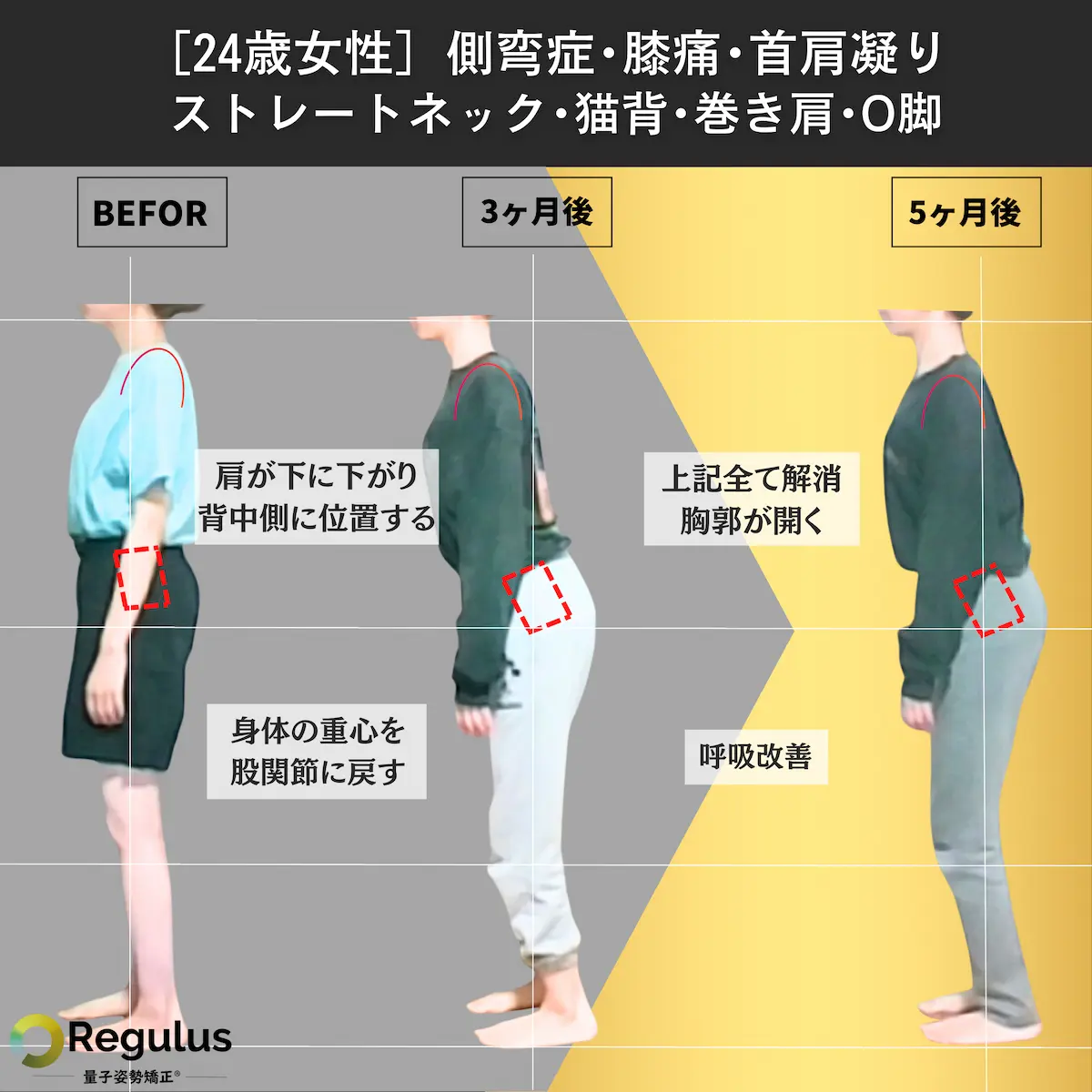 [24歳女性]側弯症・膝痛・首肩こり・ストレートネック・猫背・巻き肩・O脚