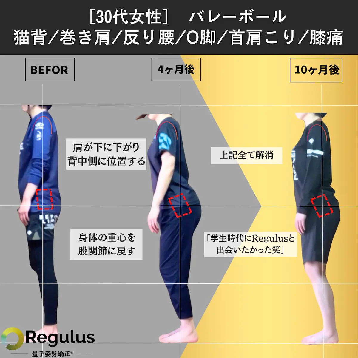 [30代女性]バレーボール　猫背／巻き肩／反り腰／O脚／首肩こり／膝痛